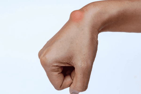 Esse calombo pode aparecer em seu corpo - Imagem via Redes Sociais