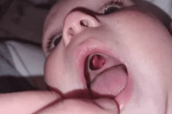 Pais ficam preocupados com abertura na boca do bebê - Imagem via Redes Sociais